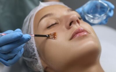 Tipos de peeling químico: descubre cuál es el ideal para renovar tu piel