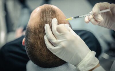 Implante capilar en Bogotá: costos, beneficios y por qué elegirlo en 2025