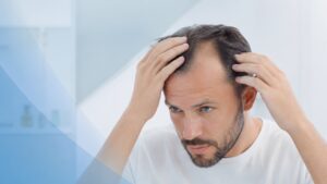 Hombre revisa la pérdida de cabello y las entradas asociadas con la alopecia androgenética