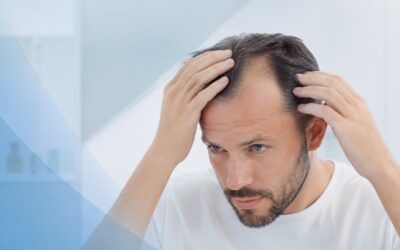 Alopecia androgenética: qué es, causas y tratamientos disponibles